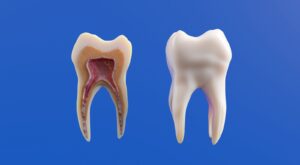 L'anatomie de la dent est représentée, avec une coupe ouverte.